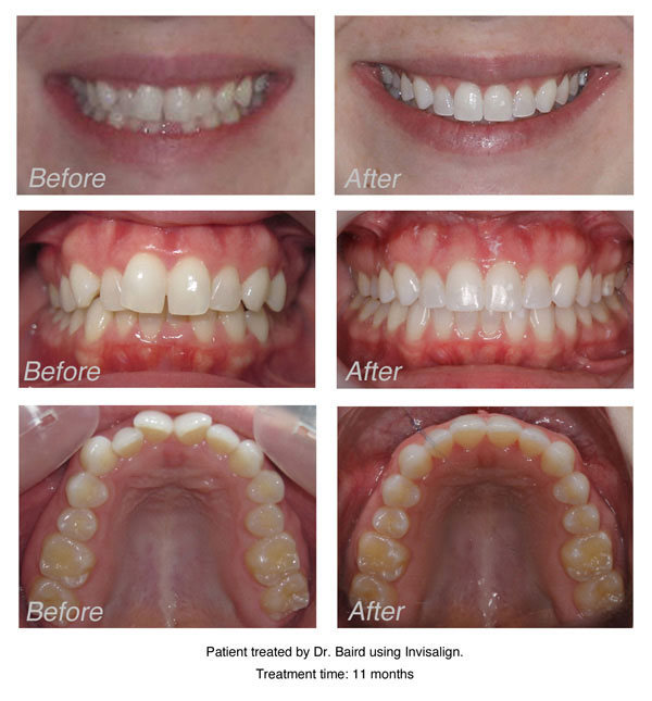 Invisalign Vs Braces Results