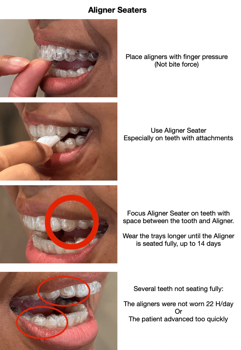 How to Use Invisalign - Baird Orthodontics